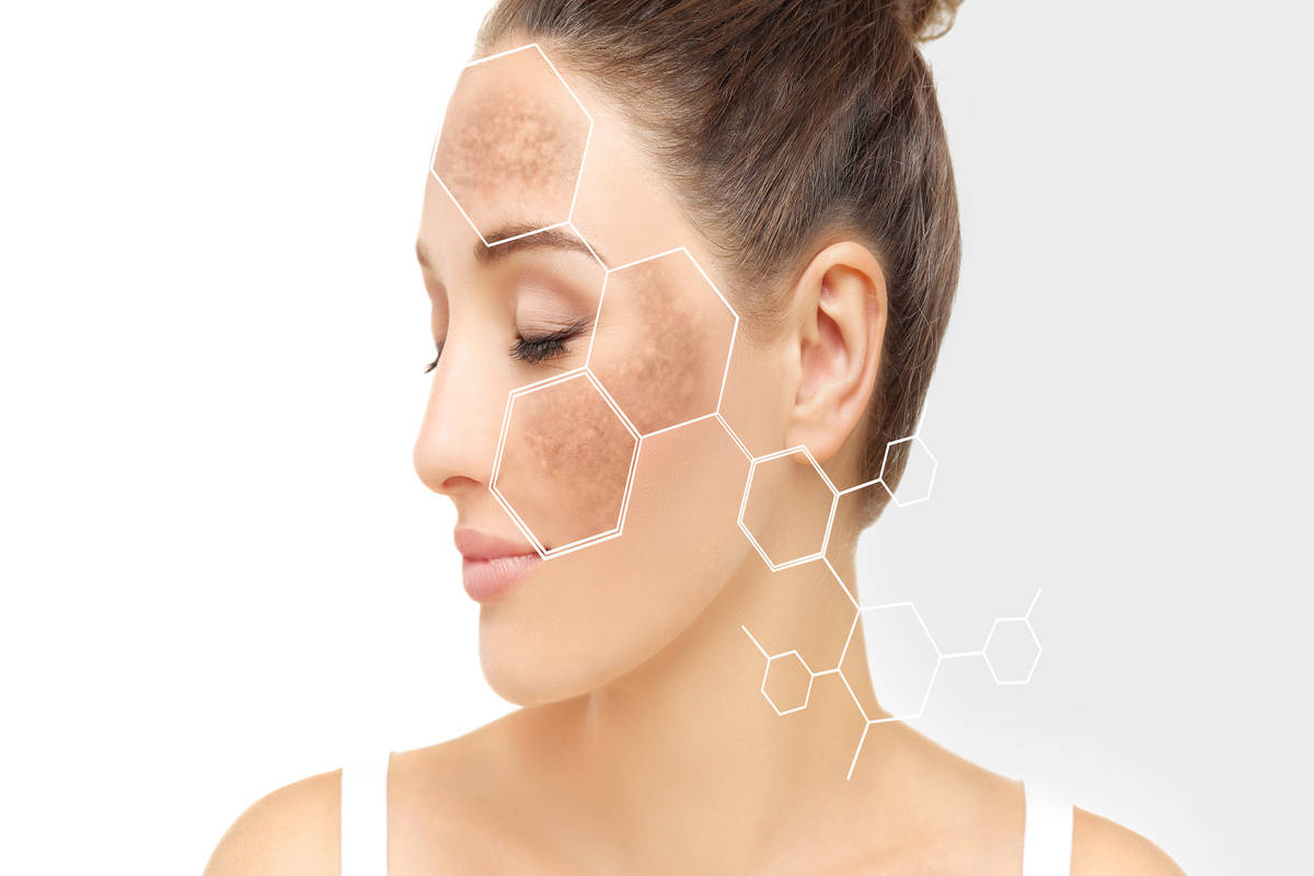 Hyperpigmentation-By-emmeskinclinic-in-Orchard-Park