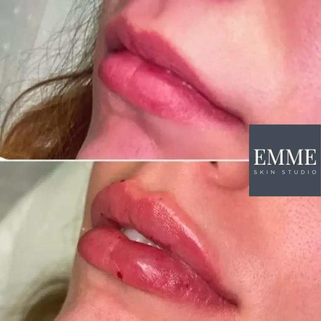 Filler before & after