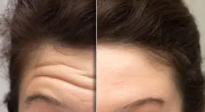 Xeomin Treatments