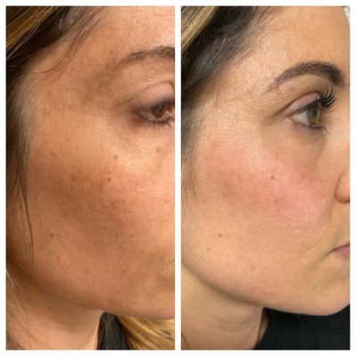 SKIN BRIGHTENING Before And After Image | EMME Medical Spa | Orchard Park, NY